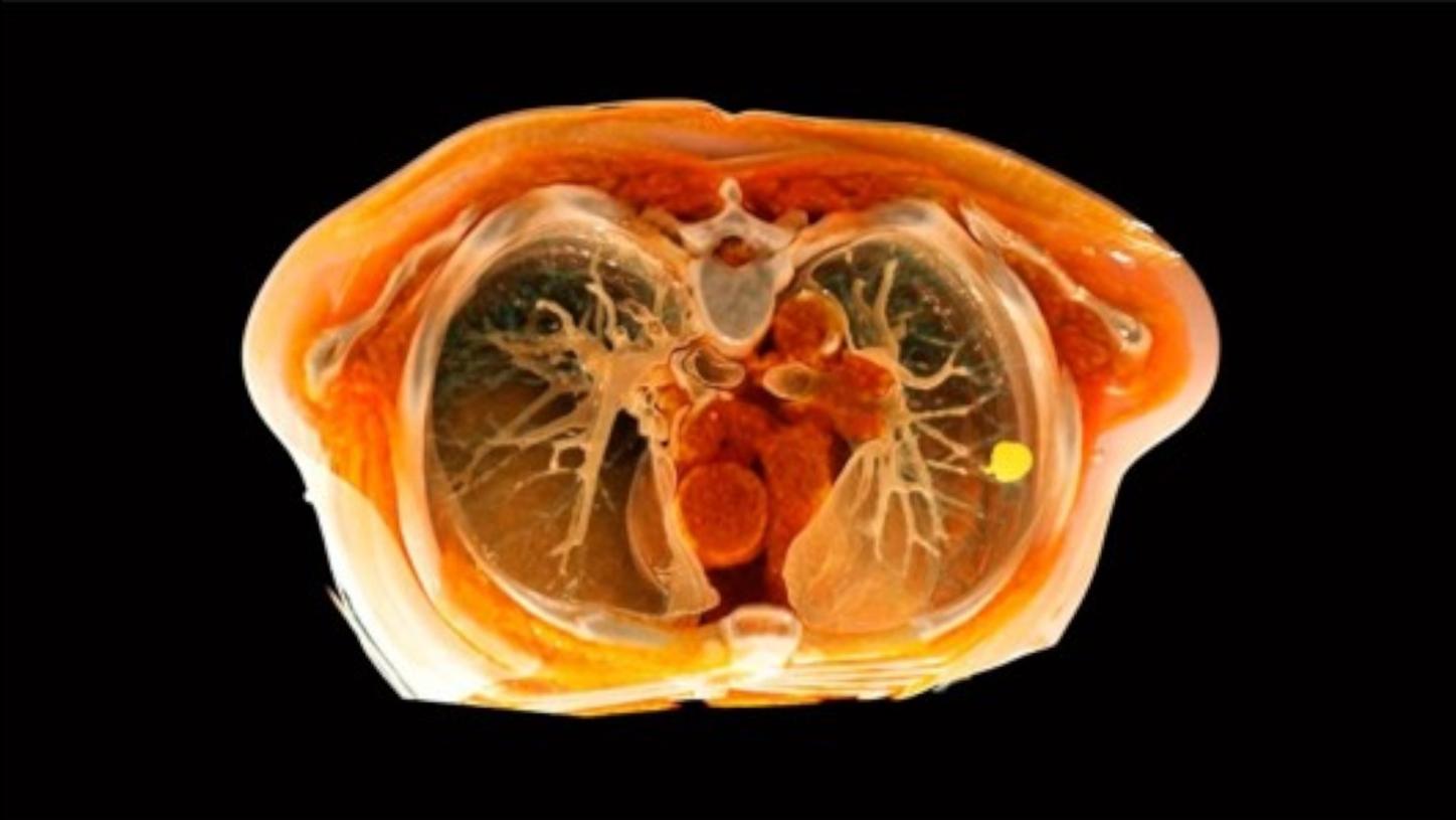 Clinical Specialties Lung Cancer
