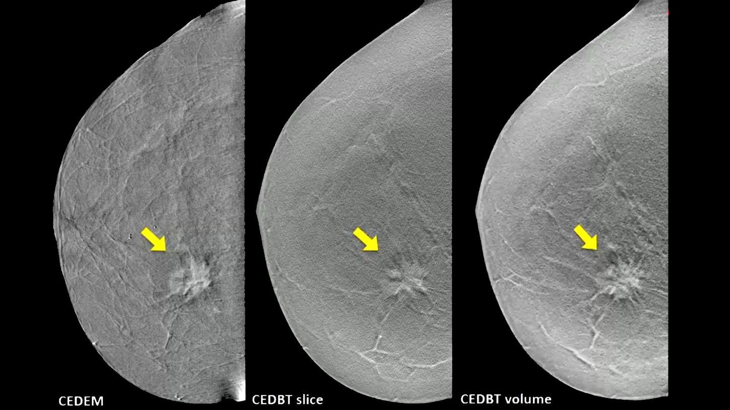 Contrast-enhanced breast tomosynthesis