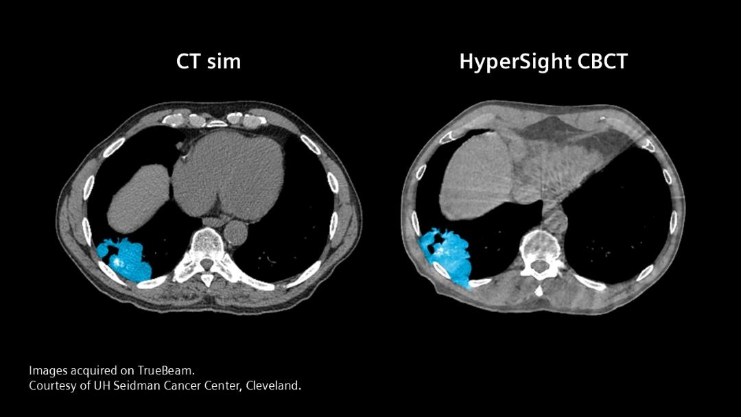 Two clinical images, the left one shows a scan from a simulation with CT where you can see a tumor. The image on the right shows a scan with HyperSight CBCT (TrueBeam) where the tumor has clearly grown.