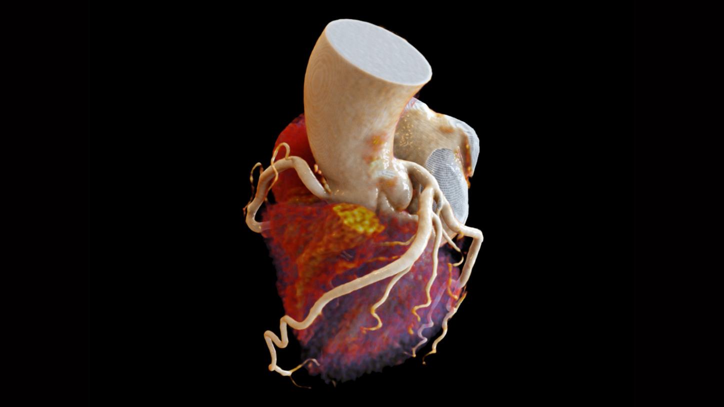 ct scan of heart