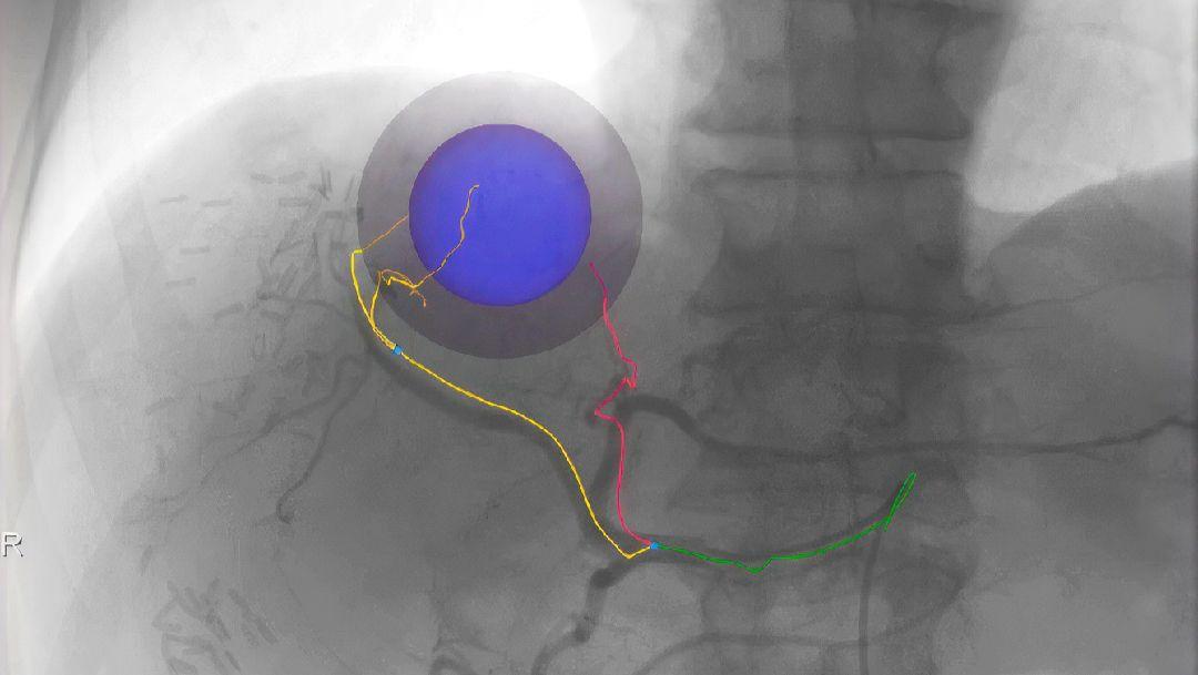 Predefined color coding facilitates finding the optimal treatment position for each tumor nodule.