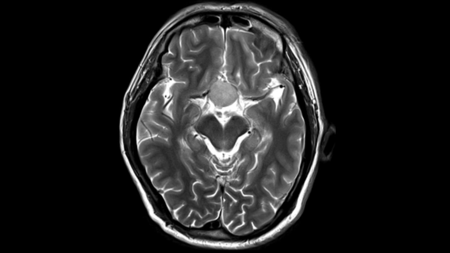 Key investigation areas for MRI are soft tissue areas like brain, abdomen, vessels, ligaments, cartilages or muscles.