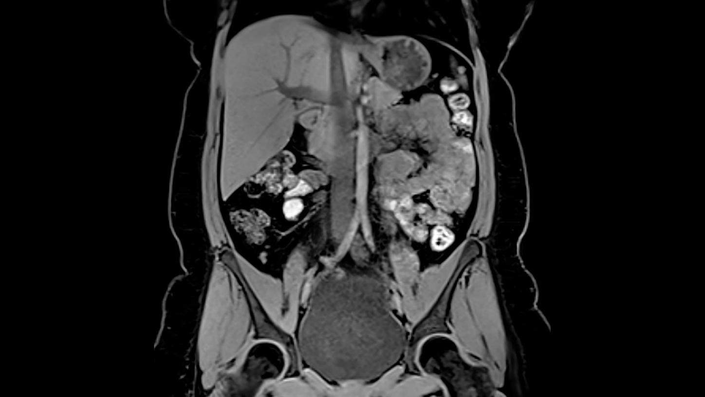Key investigation areas for MRI are soft tissue areas like brain, abdomen, vessels, ligaments, cartilages or muscles.