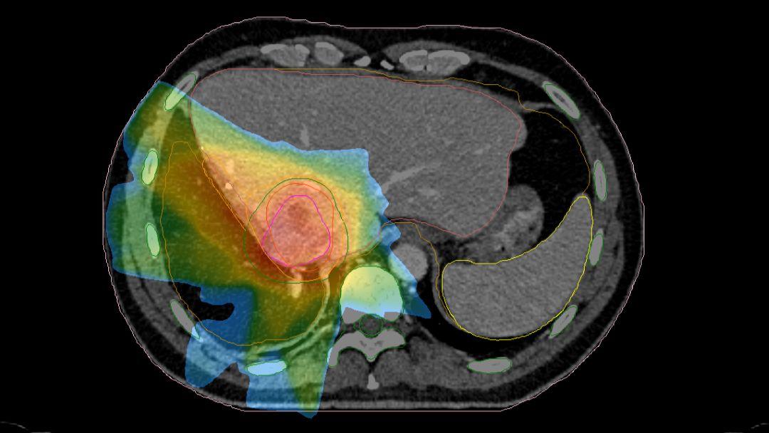 Radiation oncology image showing colour-coded organs at risk