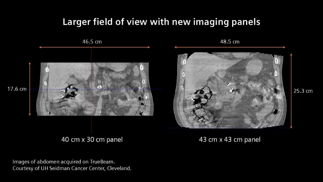 Two clinical images that shows scans of an abdomen on TrueBeam, with a 40cm x 30cm panel on the left side and a scan with a 43cm x 43cm panel on the right side. The new imaging panels provide a larger field of view.