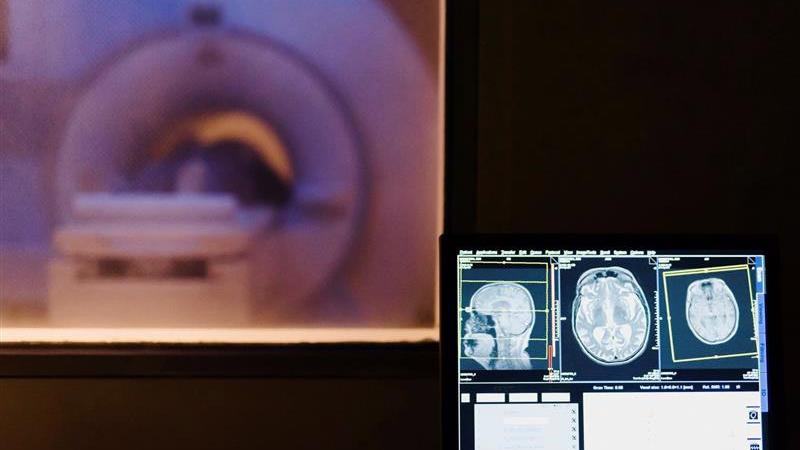 MRI scan of the brain