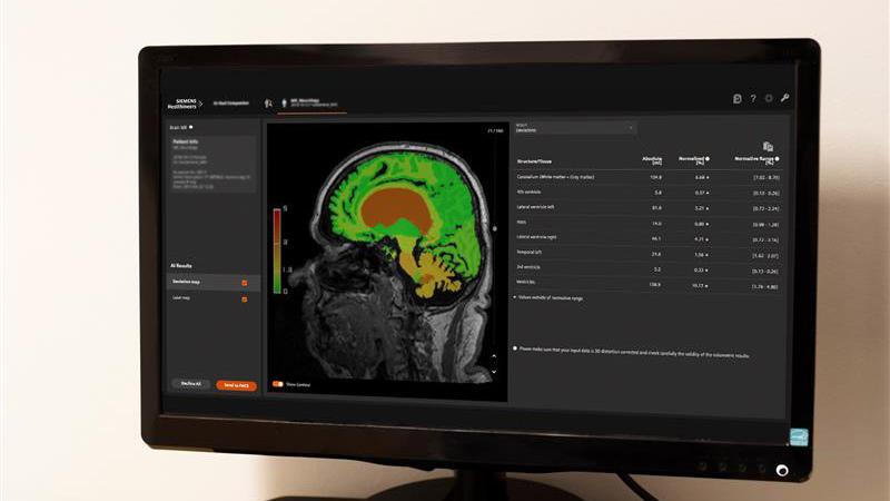 The result is a quantitative comparison of each brain structure with normative data from a healthy population.