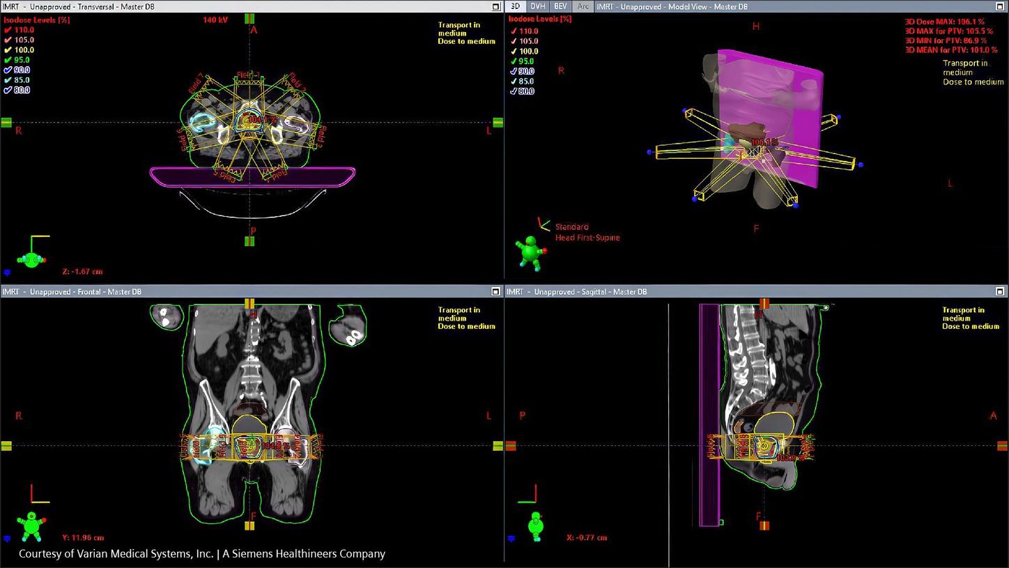 Image of Varian Eclipse Intensity Modulated Radiotherapy plan for prostate cancer patient