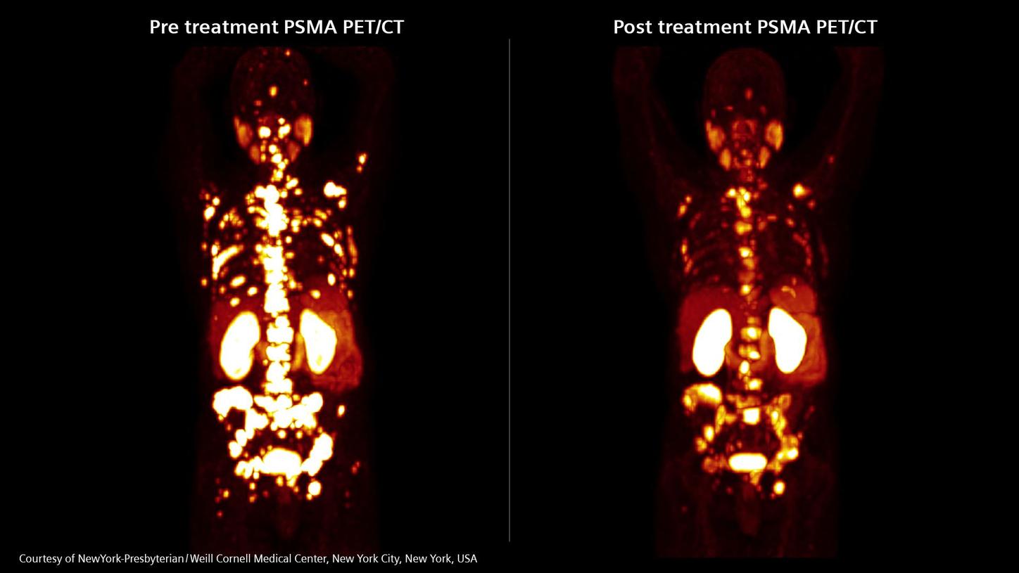 Two images: one pre and one post treatment PSMA PET/CT