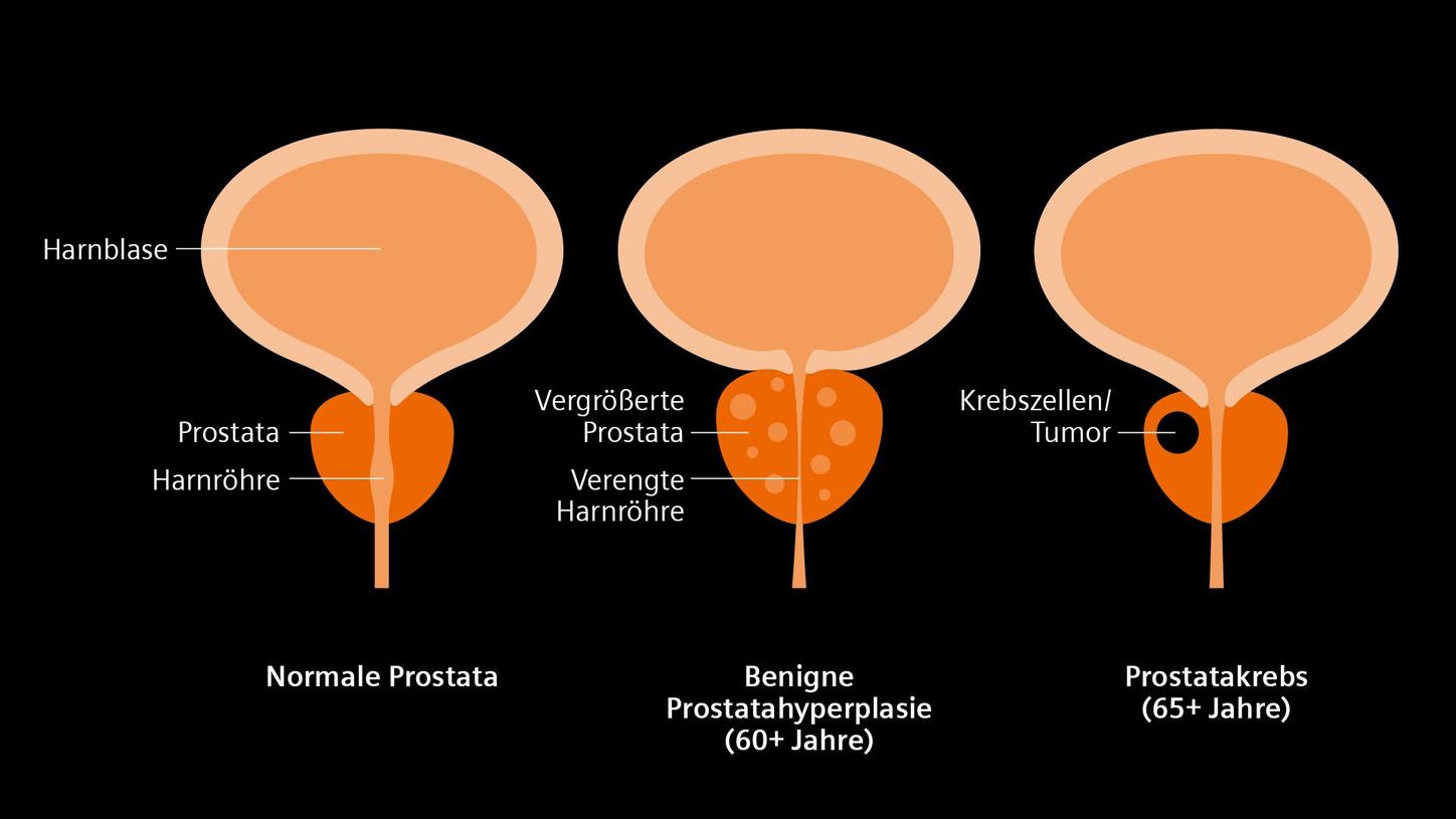 Das Bild veranschaulicht die Unterschiede zwischen einer normalen Prostata, einer gutartigen Prostatahyperplasie (BPH) und Prostatakrebs. Es zeigt, wie die Prostata, die Blase und die Harnröhre in jedem Stadium betroffen sind.