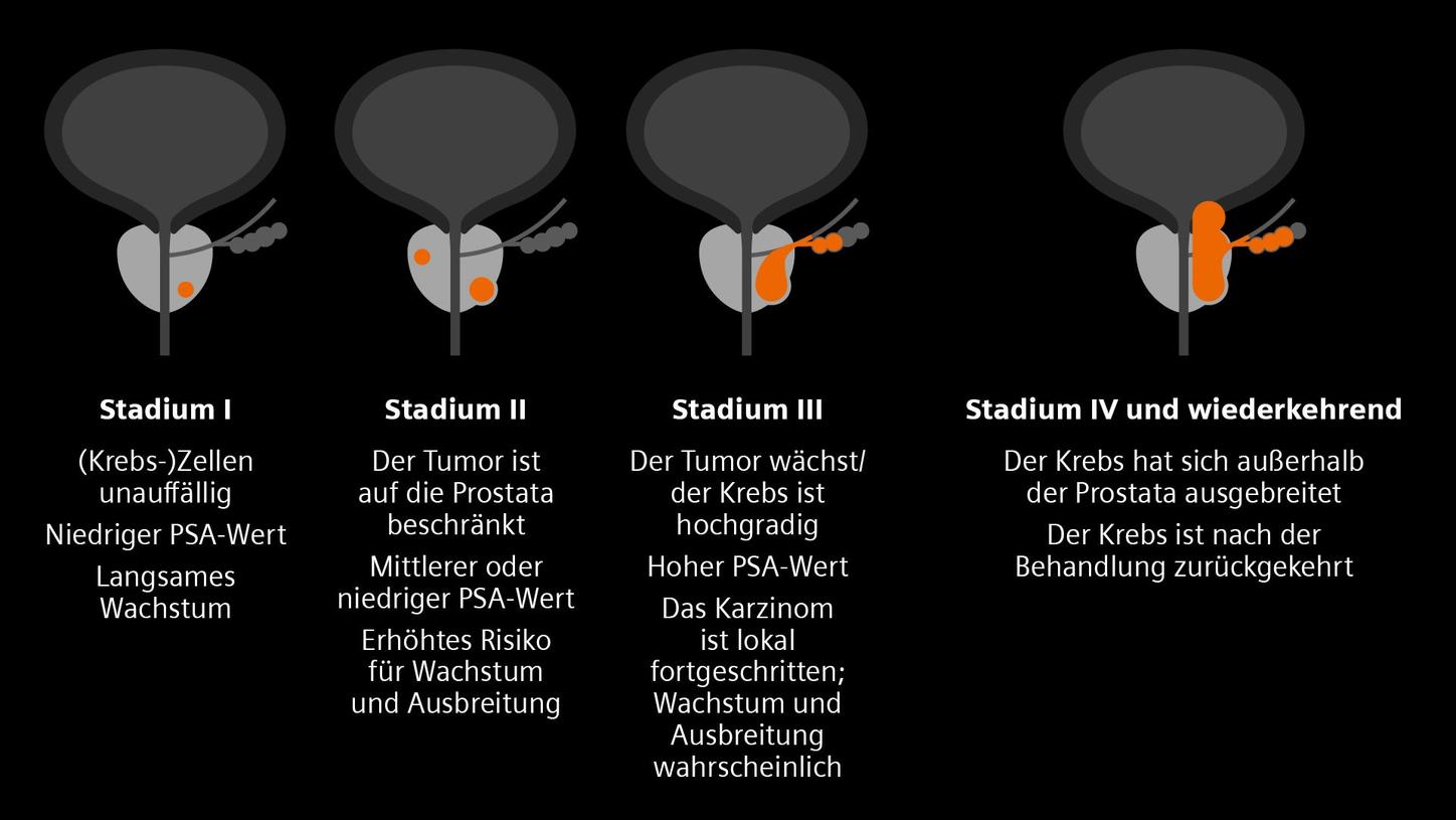 Das Fortschreiten von Prostatakrebs in vier Stadien. Die Abbildung zeigt die Veränderungen in der Prostata und dem umliegenden Gewebe in jedem Stadium.