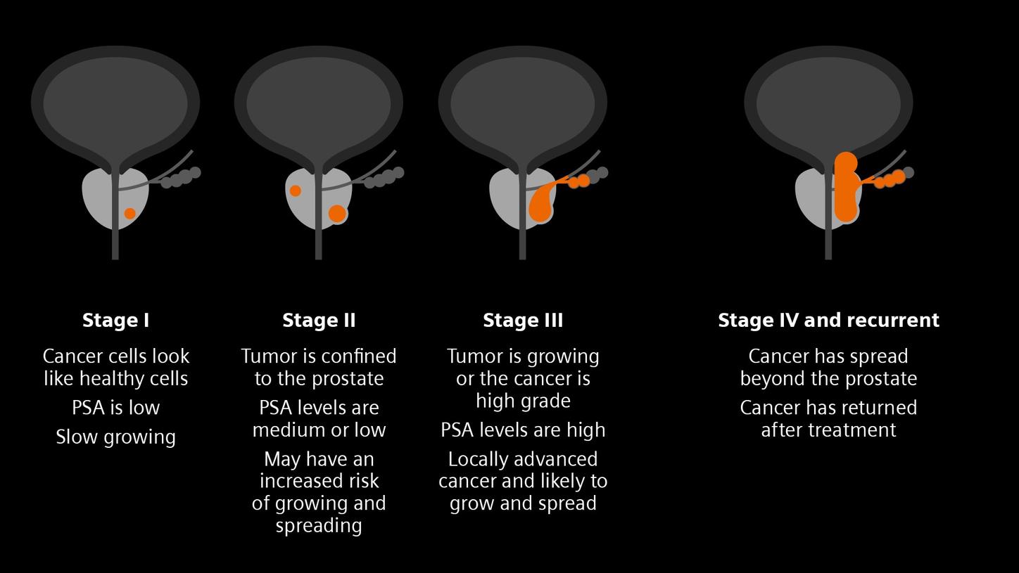 The progression of prostate cancer across four stages. The illustration highlights the changes in the prostate and surrounding tissues at each stage.