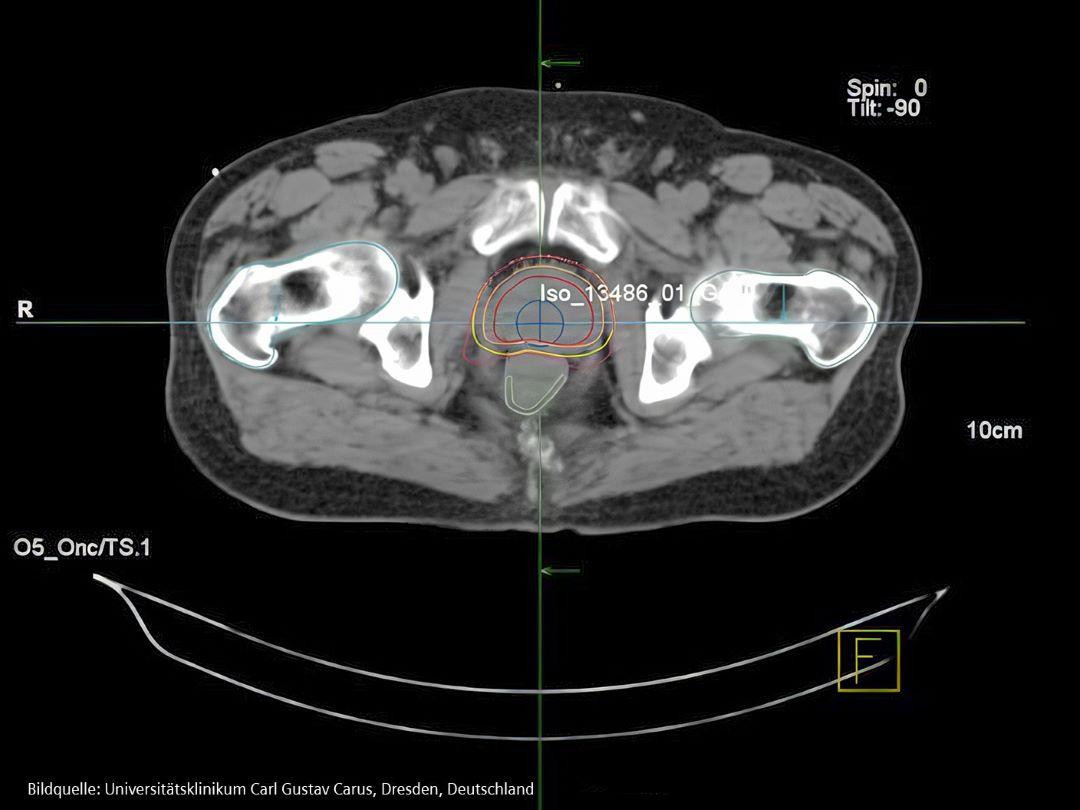 CT-Untersuchung der Prostata