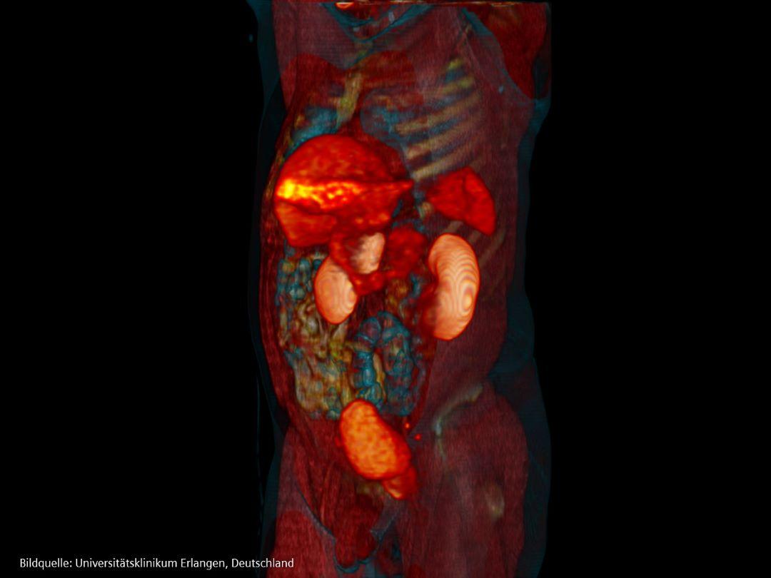 Bild eines PSMA PET/CT-Scans