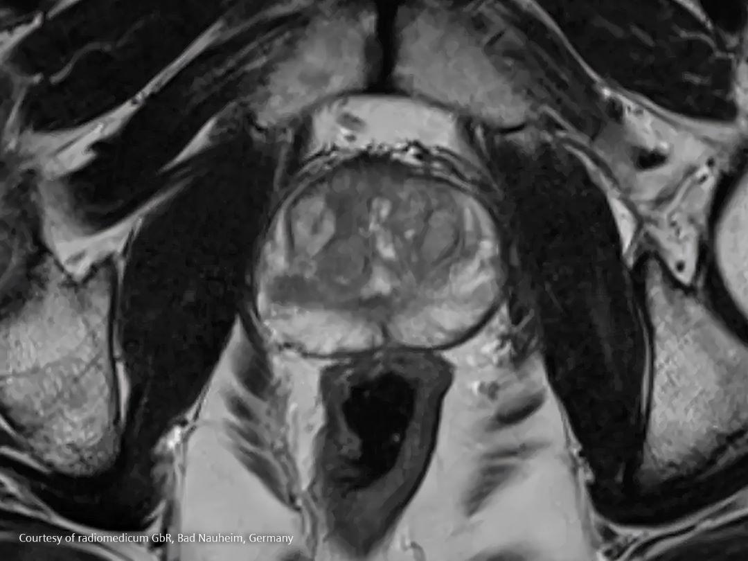 MRI scan of prostate