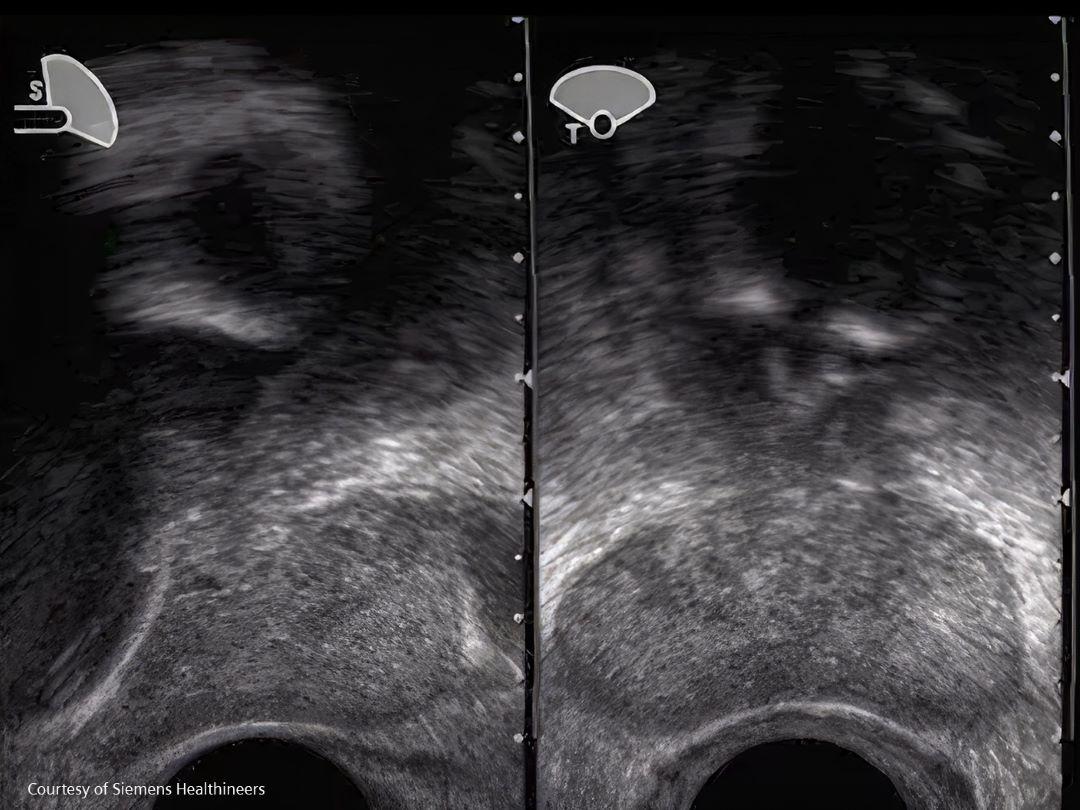 Image of transrectal ultrasound
