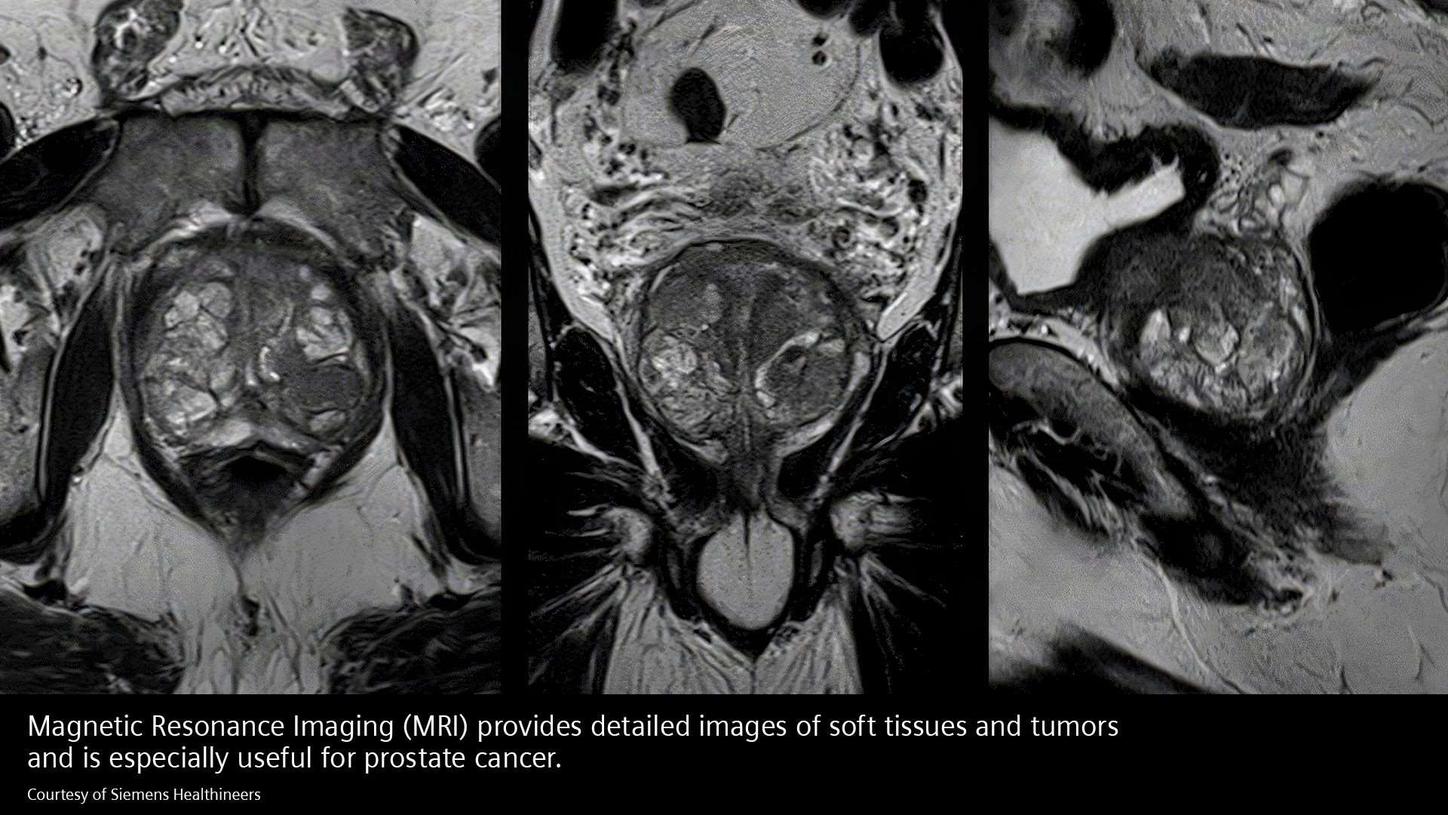 MRI provides detailed images of soft tissues and tumors and is especially useful for prostate cancer.