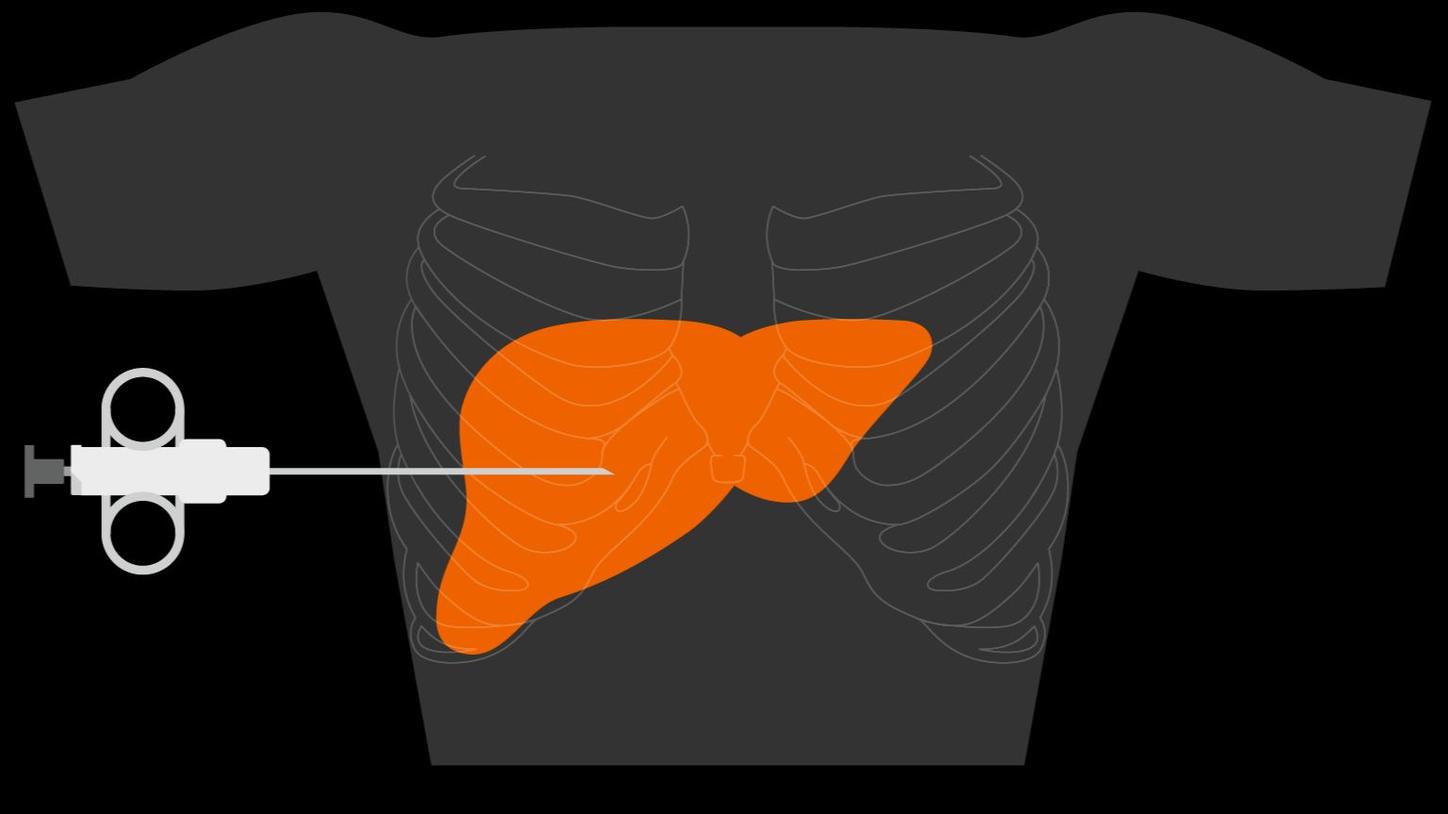 An illustration shows how a tissue sample is taken from the liver with a cannula.