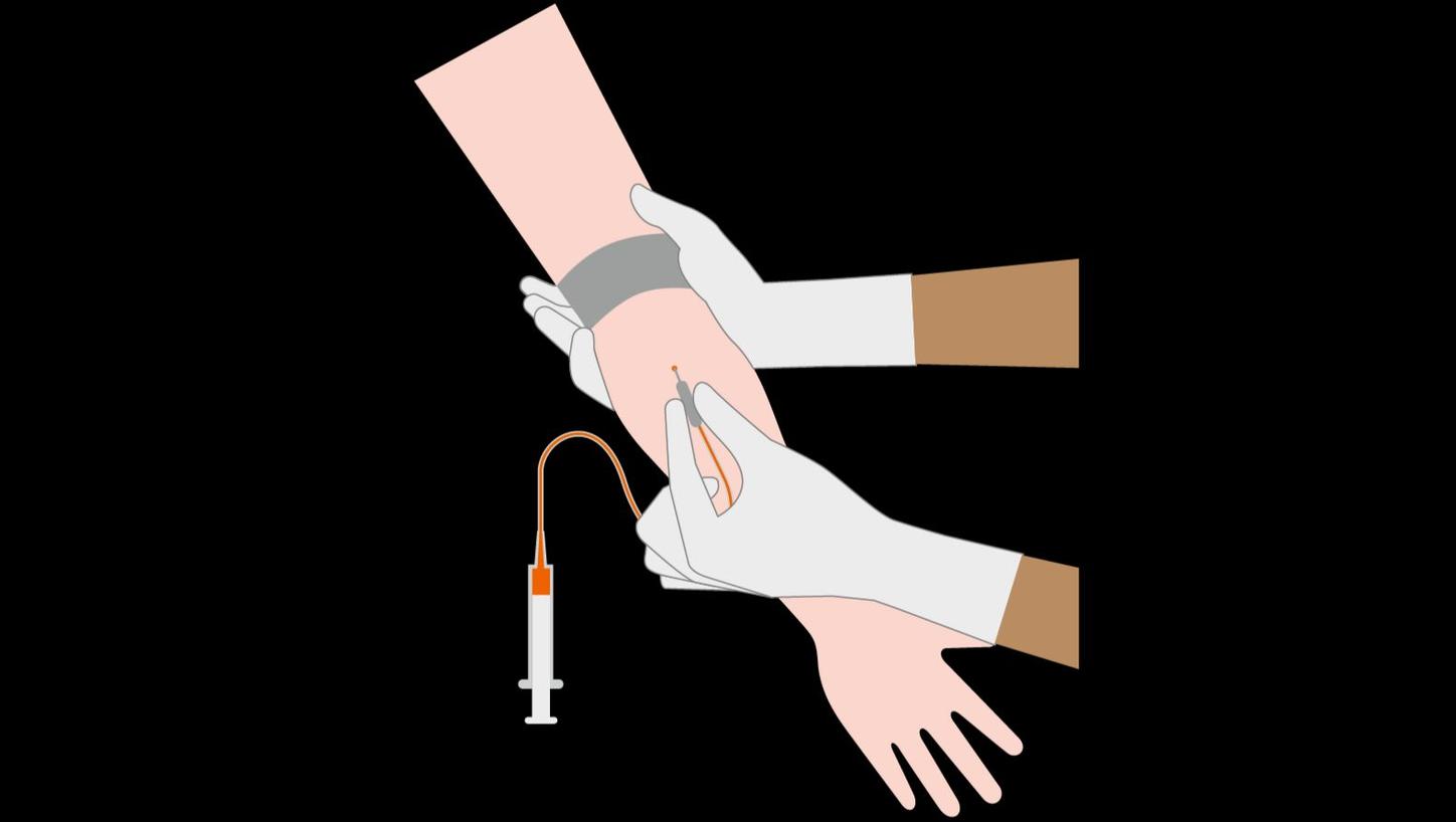 An illustration showing how a blood sample is taken from a right arm vein access.