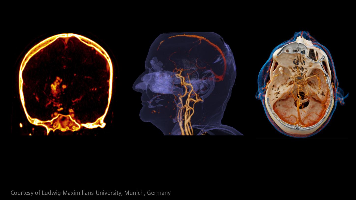 Stroke clinical images