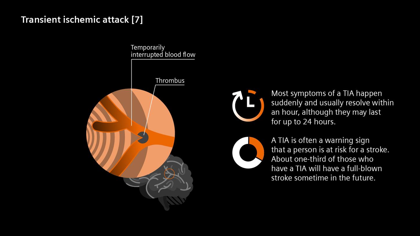 A transient ischemic attack (TIA), often referred to as a “mini-stroke”, is a stroke that lasts only a few minutes.