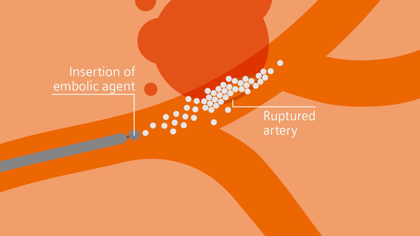 Endovascular embolization
