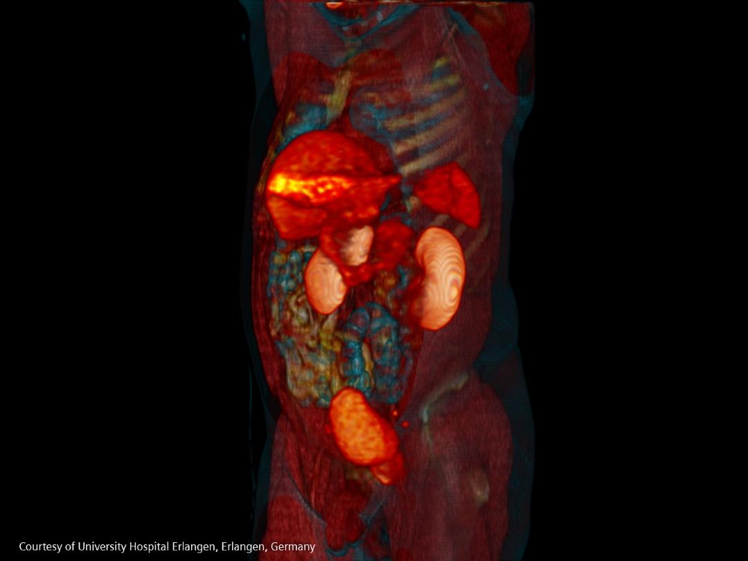Image of PSMA PET/CT scan