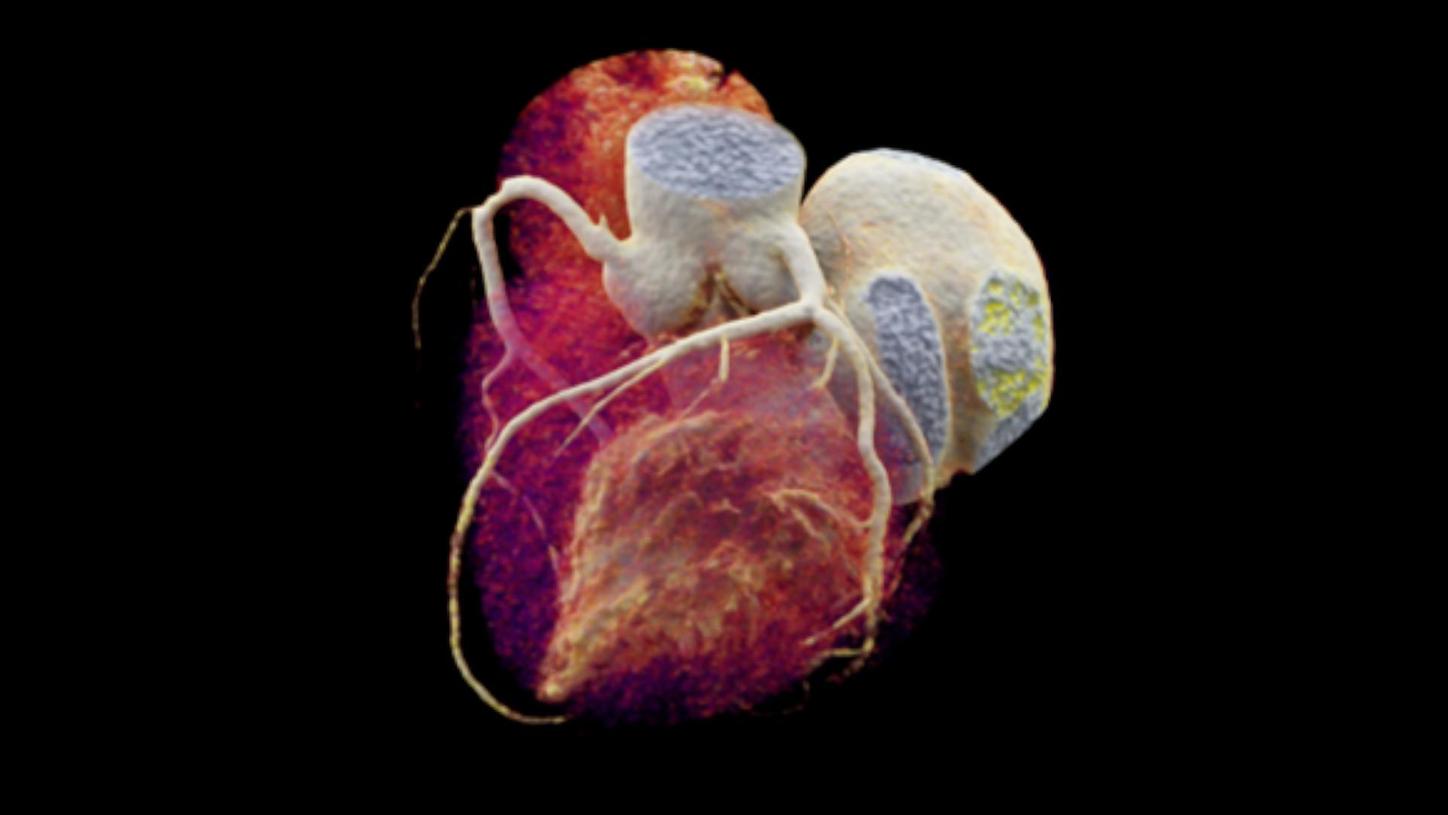 Coronary artery disease: Imaging of the heart used for coronary artery diagnosis