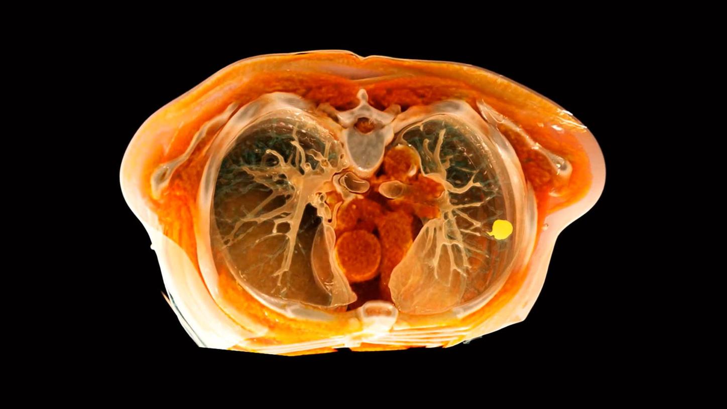 Lung cancer: Imaging of the lungs used for cancer diagnosis