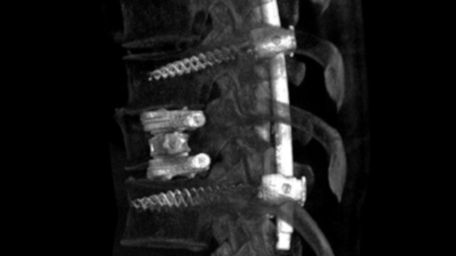 Spinal disorder: Imaging of the spine used for spinal disorder diagnosis