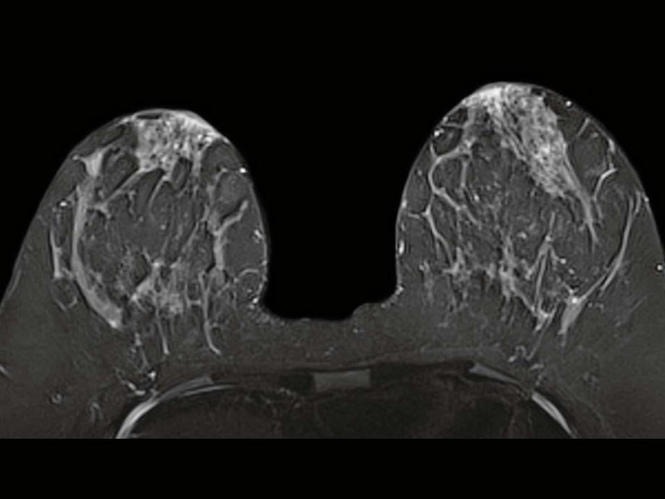 Breast MRI