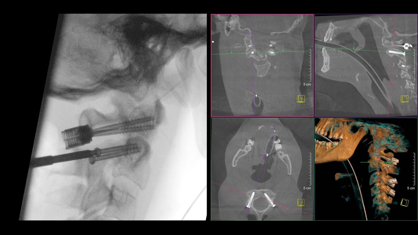 Open reduction and 3D-navigated dorsal instrumentation of C1-C3/4 with additional direct screw fixation of C2 using cannulated screws