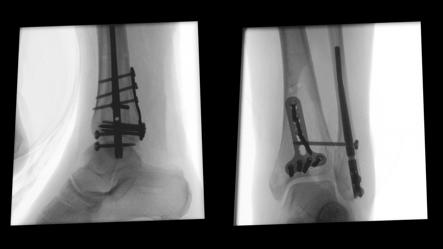 Open reduction and internal fixation with T-LCP on the dorsal tibia and fibula rod with tibiofibular set screw