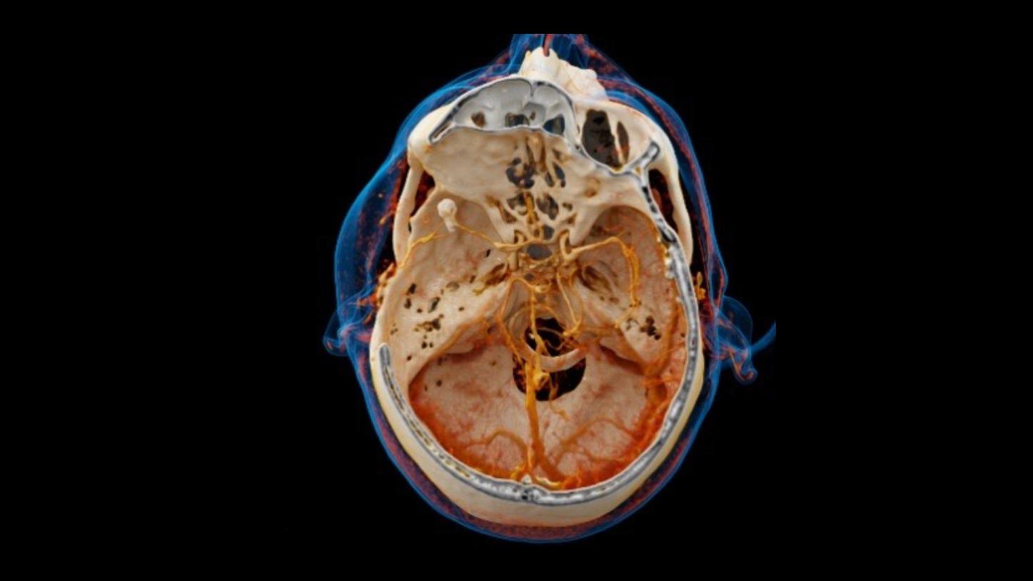 Stroke care – cinematic VRT