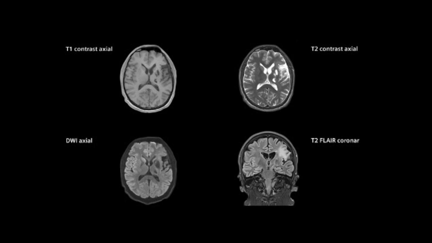Stroke care – hemorrhage visualization