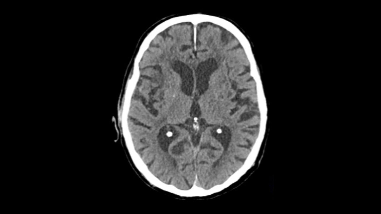 Stroke care - Native head scan