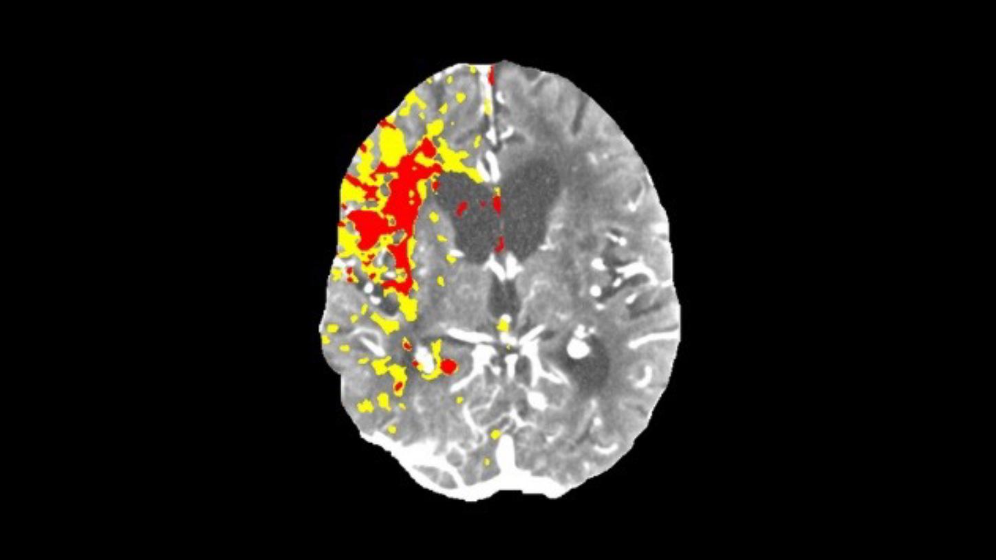 Stroke care – Perfusion scan