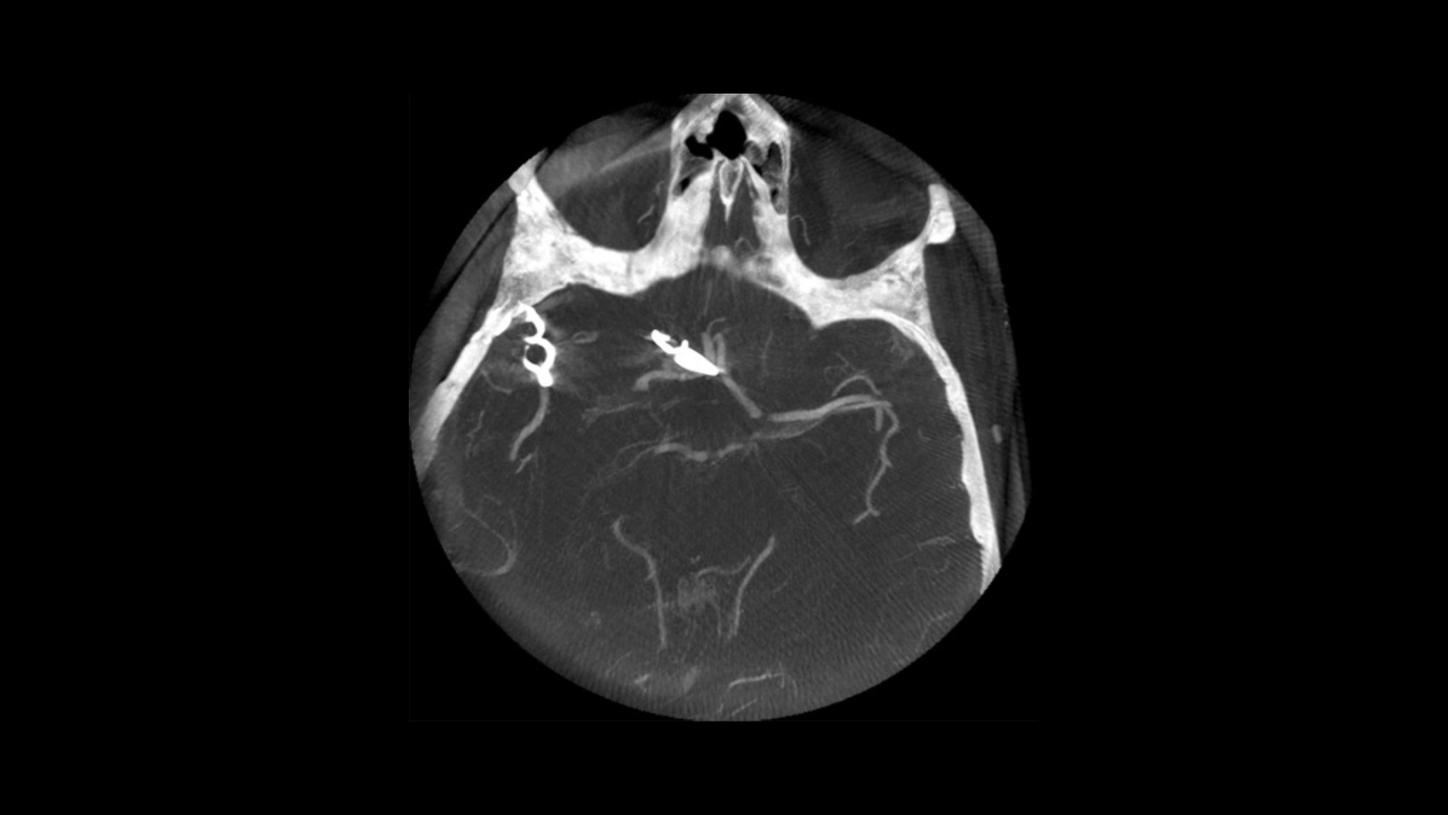 Stroke care – Post clipping MPR