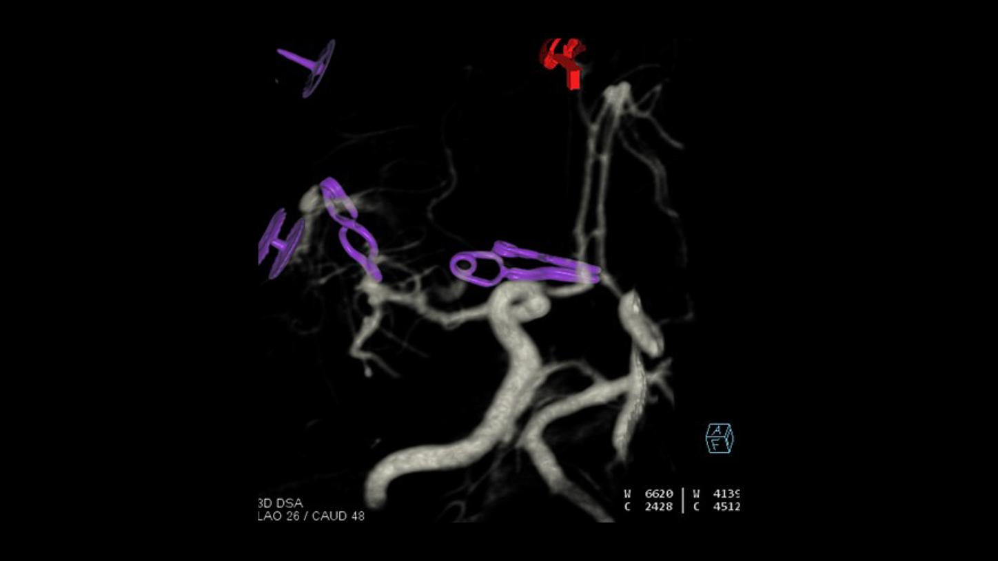 Stroke care – Post clipping VRT