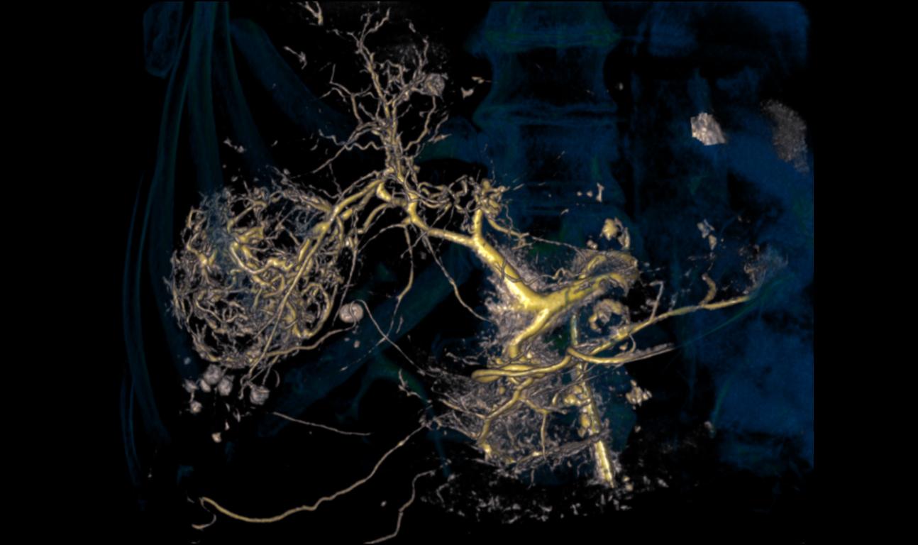 Interventional radiology equipment for interventional oncology