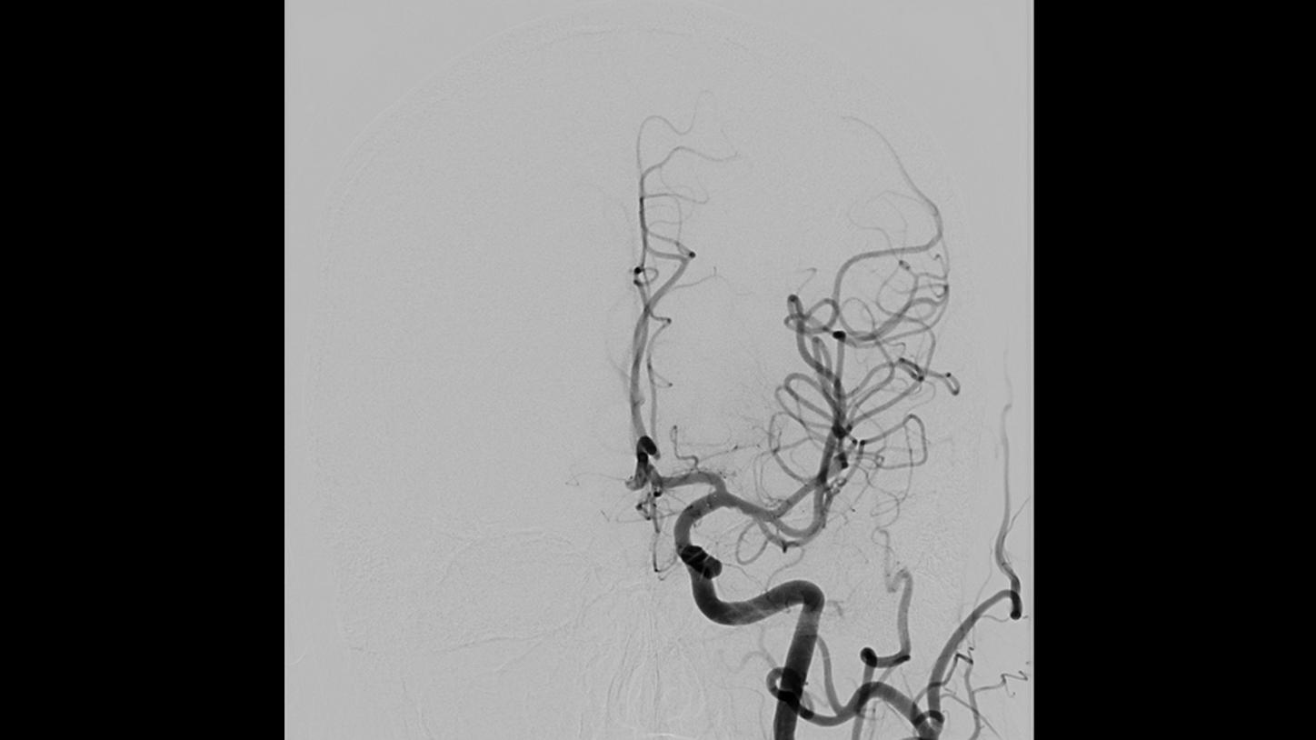 OPTIQ for interventional radiology