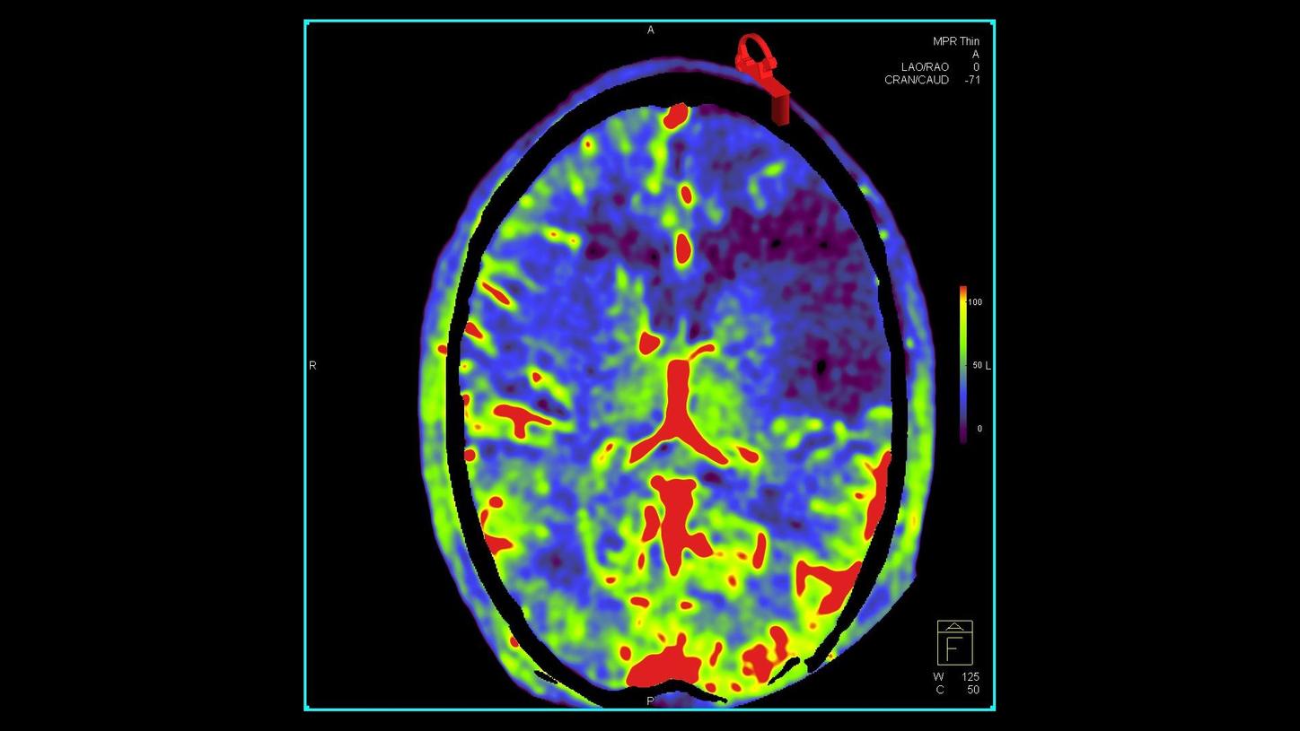 syngo PBV Neuro Image