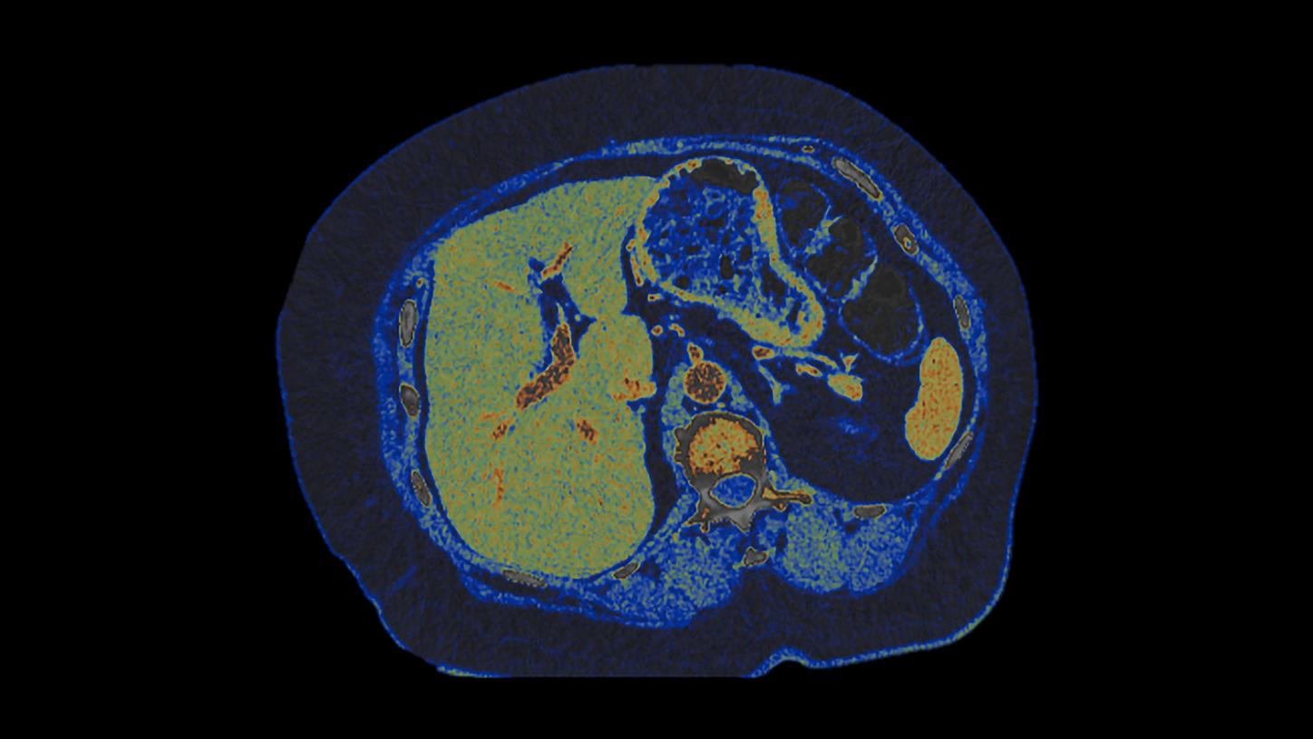 Axial view of a mono-energetic Quantum HD abdominal image of liver, pancreas, kidney, and spleen acquired by a NAEOTOM Alpha photon-counting CT.