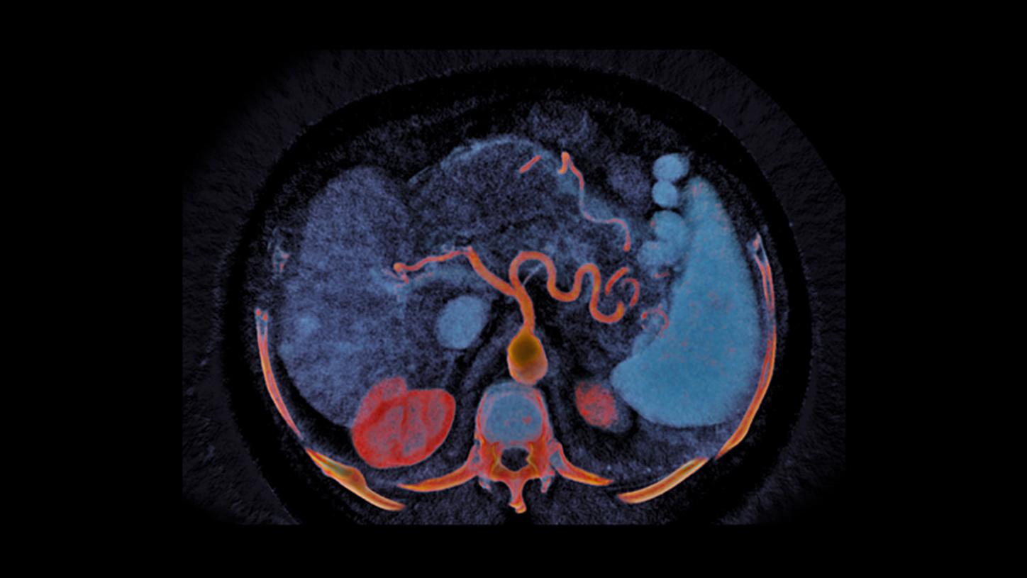 Axial clinical image of an abdomen shows a spectral multiphasic liver, acquired with a 70 keV monoenergetic and iodine map CTDIvol : 9.24 mGy.