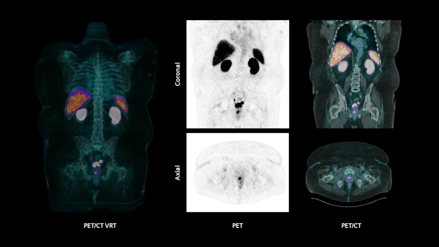 PSMA PET Clinical image Biograph Trinion