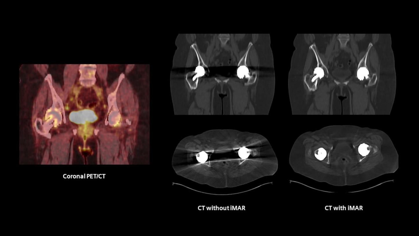 iMAR Biograph Trinion PET/CT Clinical image