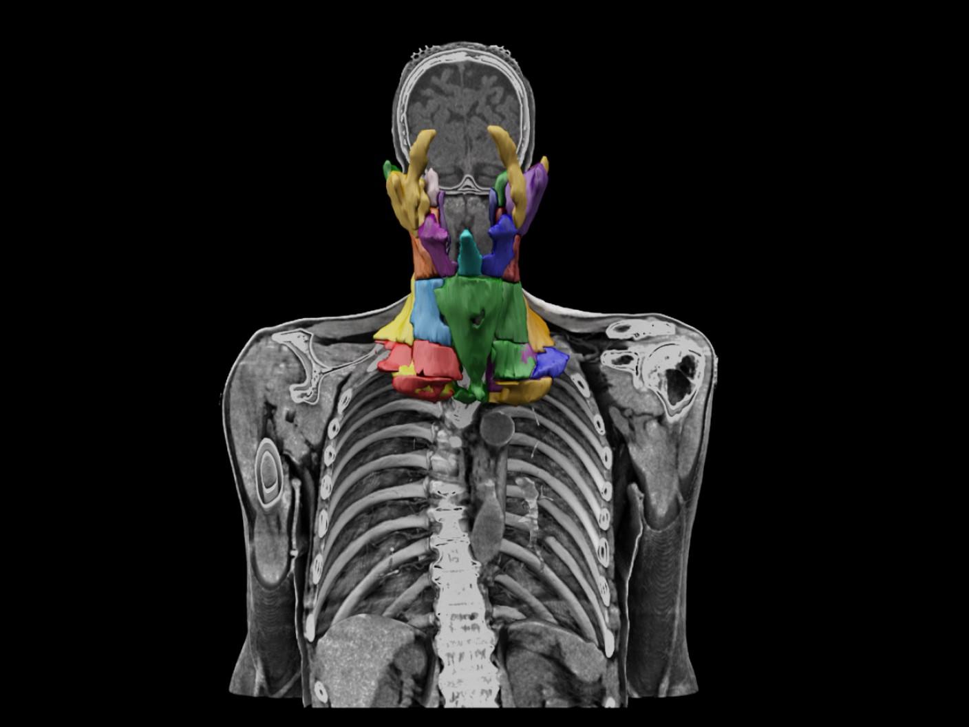 Autocontouring Siemens Healthineers