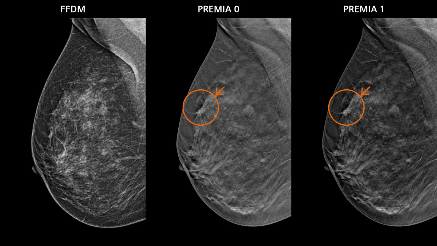 Three clinical breast images. Left: FFDM image, middle and right: PlatinumTomo images with PREMIA image flaver 0 and 1. On the PlatinumTomo images an anomaly is clearly visible.