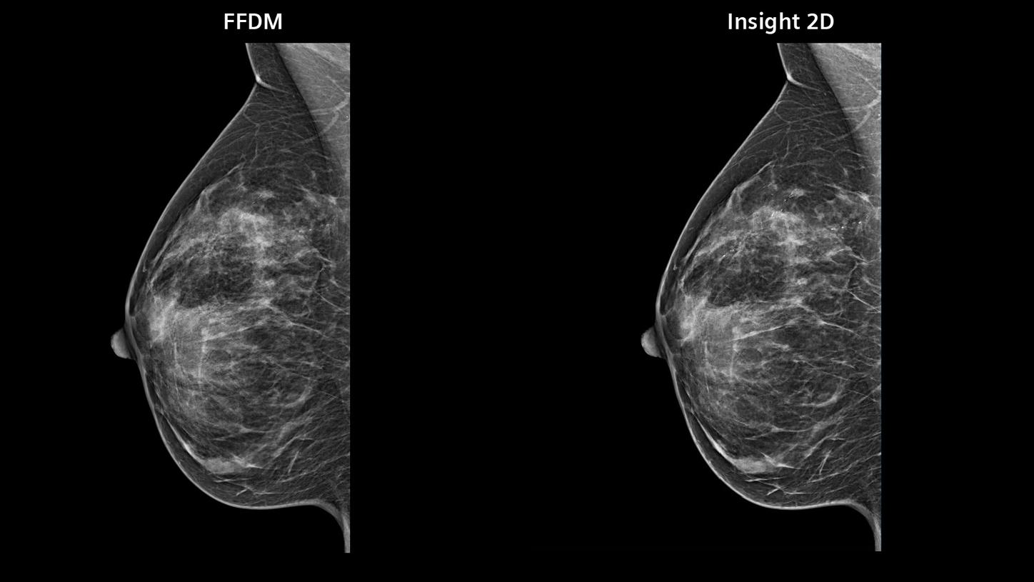 Comparison of FFDM mammogram and synthetic mammogram made with Insight 2D