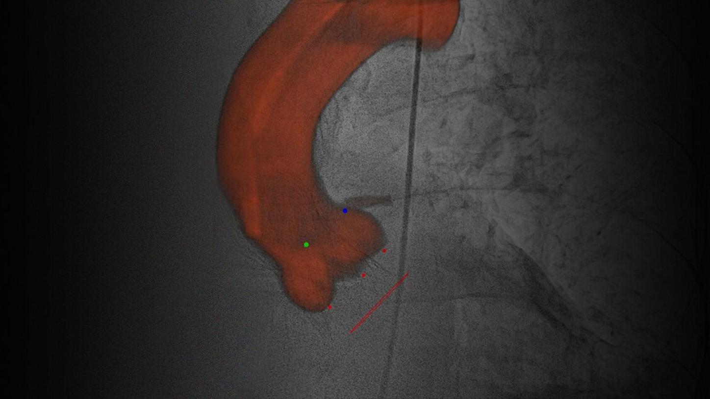 Tavi in the hybrid OR